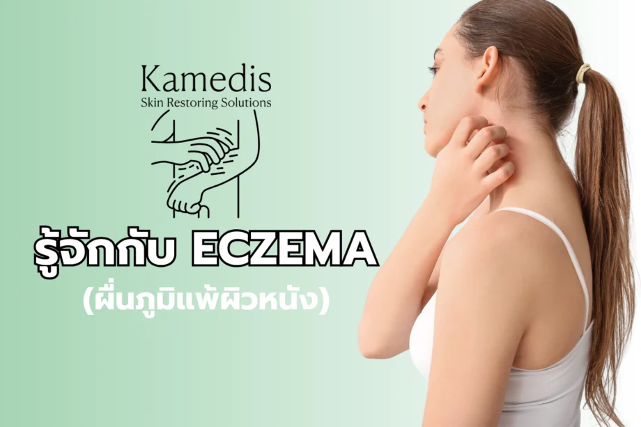 ECZEMA