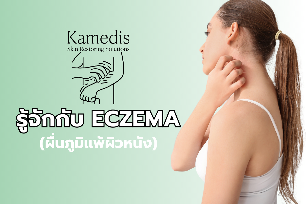 รู้จักกับ ECZEMA (ผื่นภูมิแพ้ผิวหนัง)