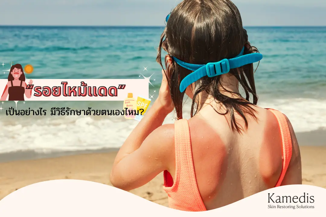 รอยไหม้แดด เป็นอย่างไร มีวิธีรักษาด้วยตนเองไหม ?