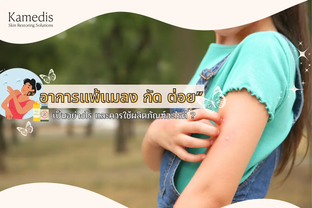อาการแพ้แมลง สัตว์ กัด ต่อย เป็นแบบไหน และควรใช้ผลิตภัณฑ์อย่างไรดี ?