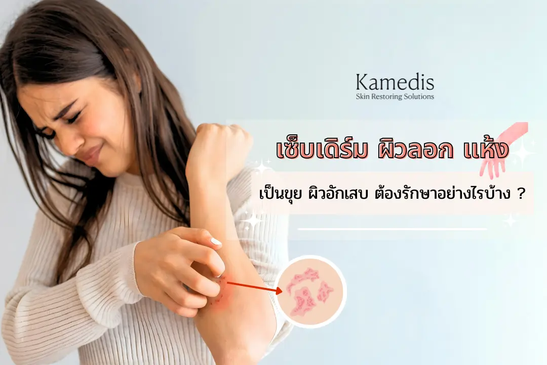 “เซ็บเดิร์ม” ผิวแห้ง ลอก เป็นขุย ผิวอักเสบ รักษาอย่างไรได้บ้าง ?