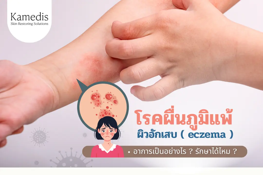 โรคผื่นภูมิแพ้ ผิวอักเสบ (Eczema) อาการเป็นอย่างไร รักษาได้ไหม ?