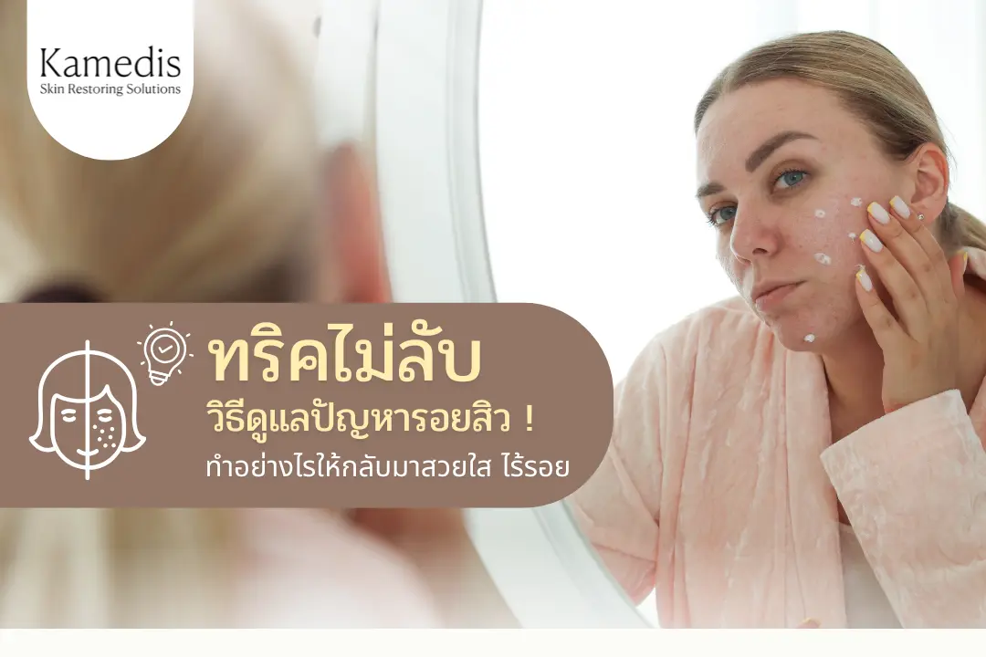 ทริคไม่ลับ ! วิธีดูแลปัญหารอยสิว ให้กลับมาสวยใส ไร้รอย