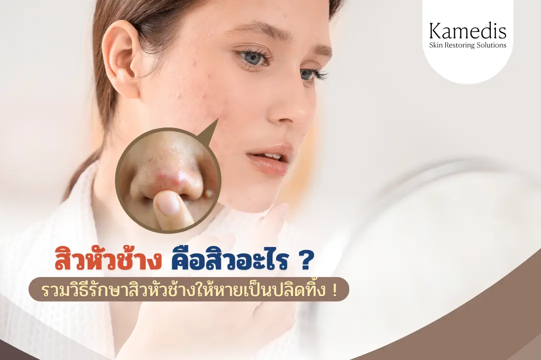 “สิวหัวช้าง” คือสิวอะไร ? รวมวิธีรักษาให้หายเป็นปลิดทิ้ง